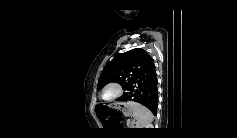 File:Acquired tracheo-esophageal fistula (Radiopaedia 51356-57103 Sagittal C+ arterial phase 2).jpg