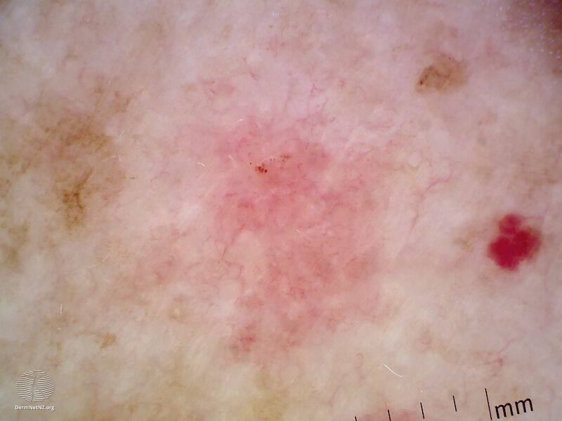 File:Actinic keratosis on nonfacial skin (DermNet NZ actinic-keratosis-arm).jpg