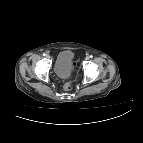 File:Acute-on-chronic Crohn disease with enteroenteric fistula (Radiopaedia 66686-75987 B 76).jpg