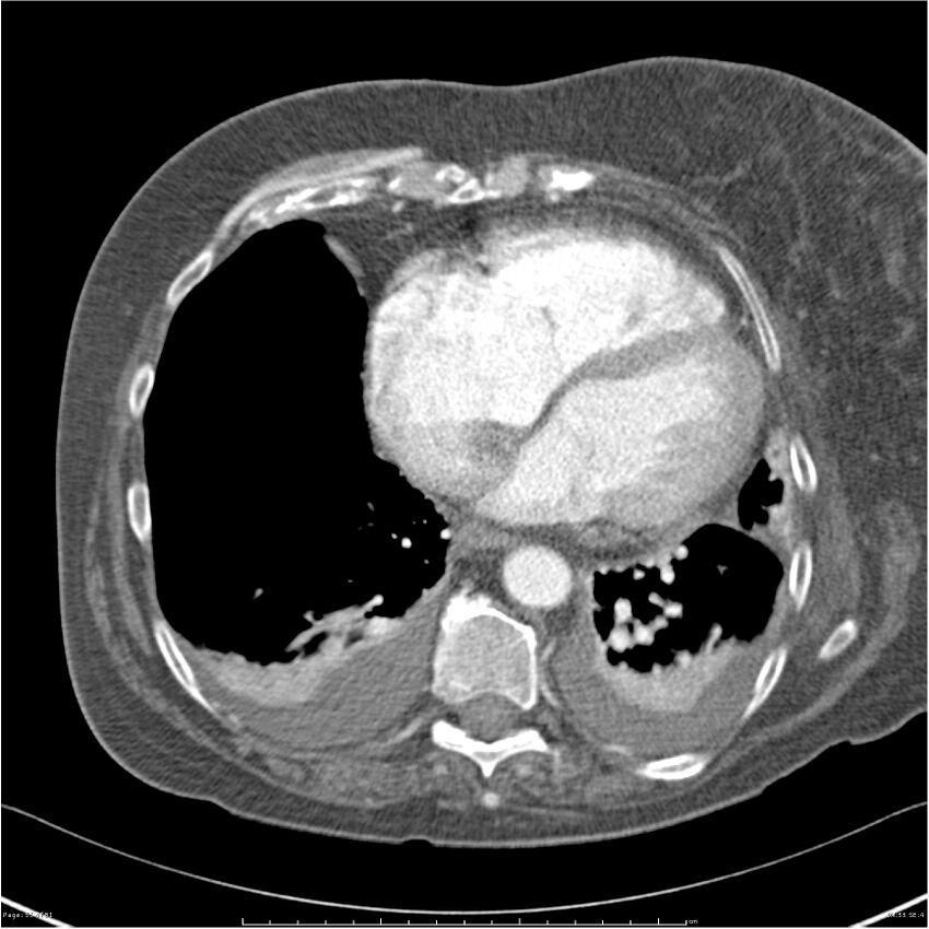 Acute-on-chronic pulmonary emboli (Radiopaedia 27925-28169 C+ CTPA 55).jpg