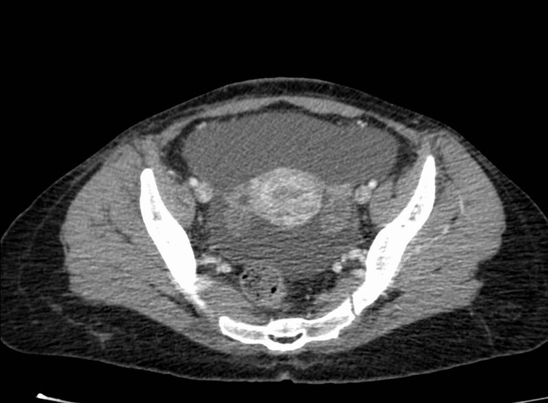 File:Acute Budd-Chiari syndrome (Radiopaedia 60858-68638 Axial C+ portal venous phase 252).jpg
