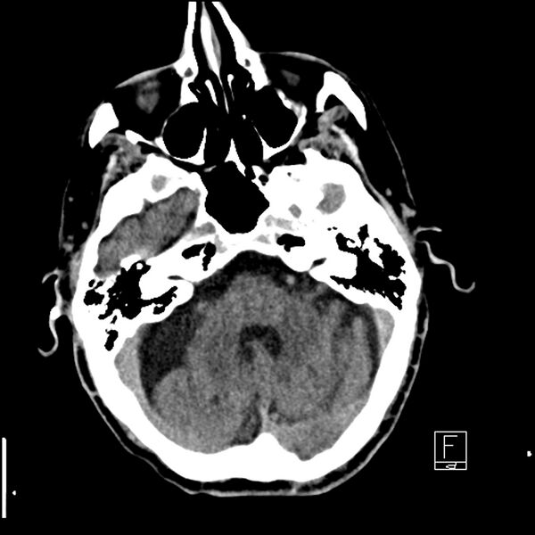 File:Acute ICA ischemic penumbra due to high-grade CCA stenosis (CT perfusion) (Radiopaedia 72038-82529 Axial non-contrast 11).jpg
