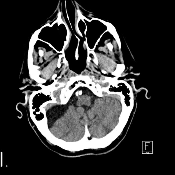 File:Acute ICA ischemic penumbra due to high-grade CCA stenosis (CT perfusion) (Radiopaedia 72038-82529 Axial non-contrast 6).jpg