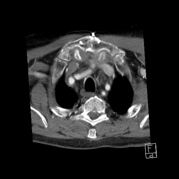 File:Acute ICA ischemic penumbra due to high-grade CCA stenosis (CT perfusion) (Radiopaedia 72038-82530 Axial C+ arterial phase 72).jpg