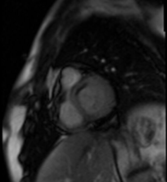 File:Acute anteroseptal myocardial infarction (Radiopaedia 68409-77945 Short axis (basal) Perfusion 18).jpg