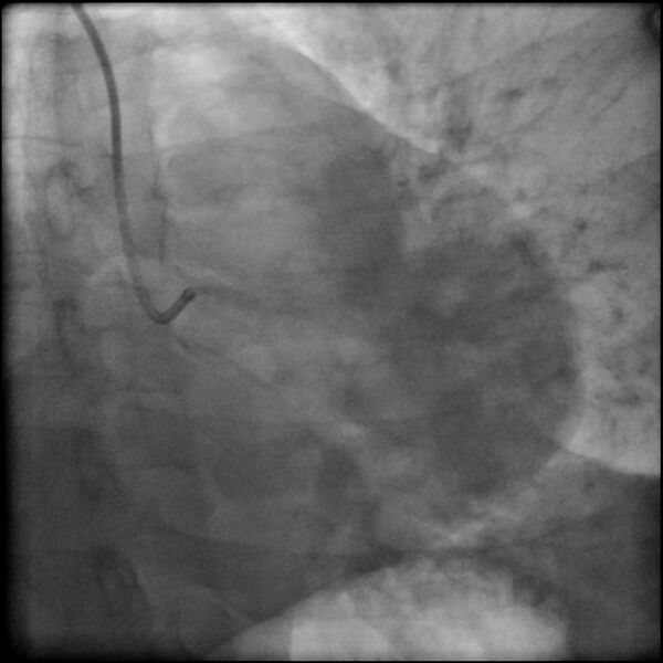 File:Acute anteroseptal myocardial infarction (Radiopaedia 68409-77946 LAO caudal (spider view) LAD and CX 6).jpg