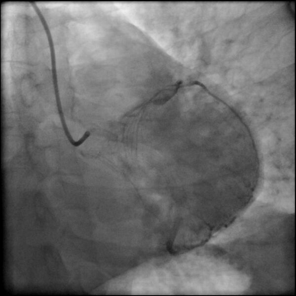 File:Acute anteroseptal myocardial infarction (Radiopaedia 68409-77946 LAO caudal (spider view) LAD and CX 63).jpg
