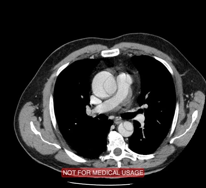 File:Acute aortic dissection - Stanford type A (Radiopaedia 40661-43285 Axial C+ portal venous phase 20).jpg