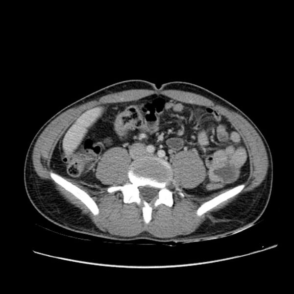 File:Acute appendicitis (Radiopaedia 27049-27227 Axial C+ portal venous phase 44).jpg
