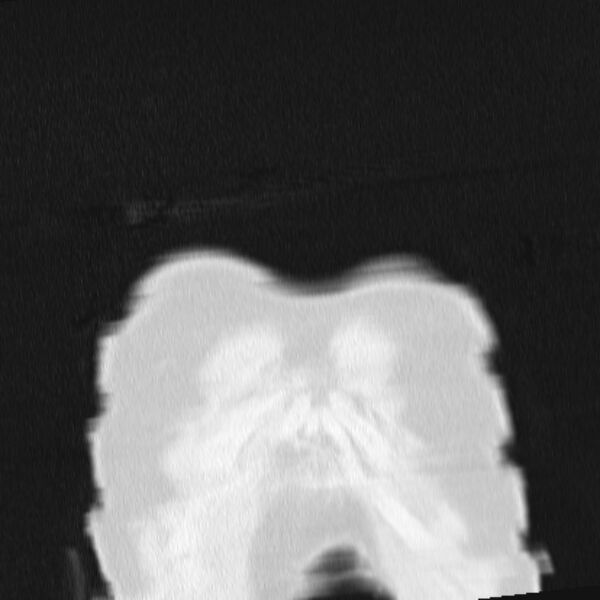 File:Acute aspiration pneumonitis (Radiopaedia 33605-34703 Coronal lung window 6).jpg