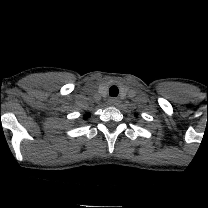 Acute chest syndrome - sickle cell disease (Radiopaedia 42375-45499 Axial C+ CTPA 13).jpg