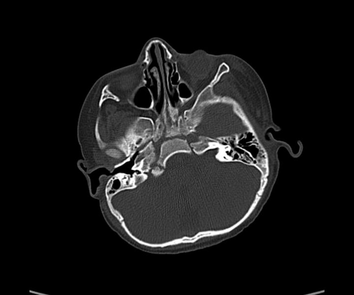 File:Acute hemorrhagic contusion (Radiopaedia 63660-72336 Axial bone window 16).jpg