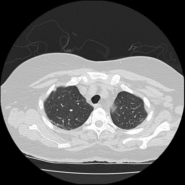 File:Acute interstitial pneumonitis (Radiopaedia 45404-49452 Axial lung window 17).jpg