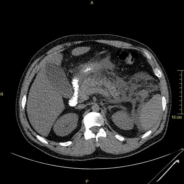 File:Acute pancreatitis (Radiopaedia 23231-23290 Axial oral contrast 41).JPG
