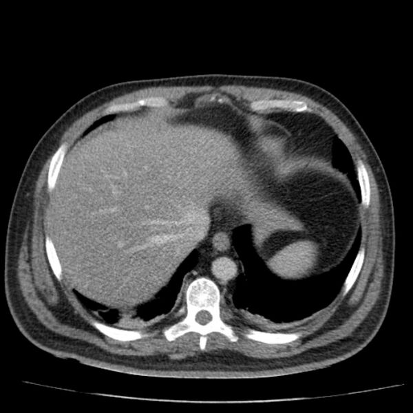 File:Acute pancreatitis (Radiopaedia 26663-26813 Axial C+ portal venous phase 12).jpg