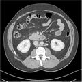 Acute pancreatitis - mild (Radiopaedia 27796-28033 C+ portal venous phase 23).jpg