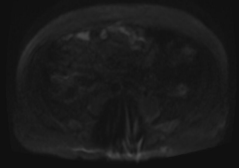 File:Acute portal vein thrombosis (Radiopaedia 73198-83925 Axial DWI 58).jpg