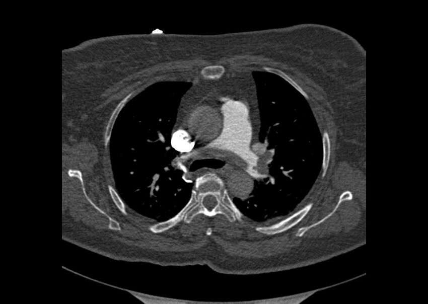 Acute pulmonary embolism (Radiopaedia 29938-30466 Axial C+ CTPA 36).jpg
