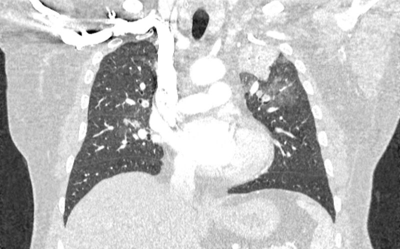 File:Acute pulmonary embolism with pulmonary infarcts (Radiopaedia 77688-89908 Coronal lung window 42).jpg