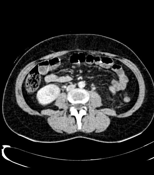 File:Acute pyelonephritis (Radiopaedia 40264-42816 Axial C+ portal venous phase 39).jpg