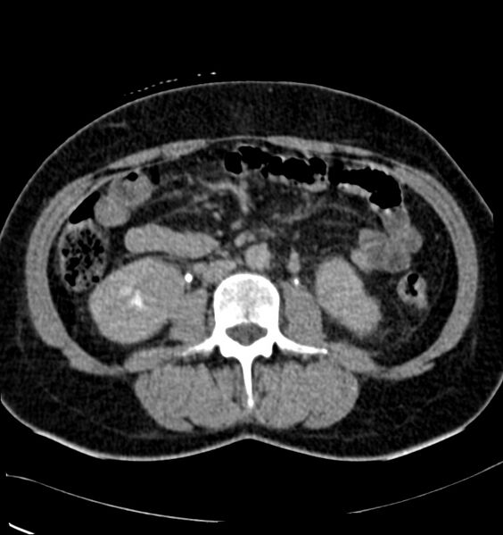 File:Acute pyelonephritis (Radiopaedia 40264-42816 Axial renal excretory phase 15).jpg