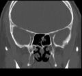 Acute sinusitis (Radiopaedia 23161-23215 Coronal bone window 45).jpg