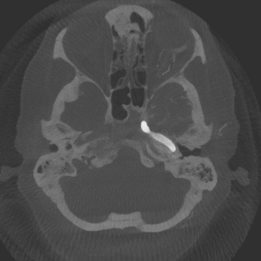 Acute subarachnoid hemorrhage and accessory anterior cerebral artery (Radiopaedia 69231-79010 C 10).jpg