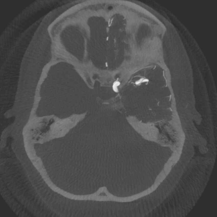 Acute subarachnoid hemorrhage and accessory anterior cerebral artery (Radiopaedia 69231-79010 C 17).jpg
