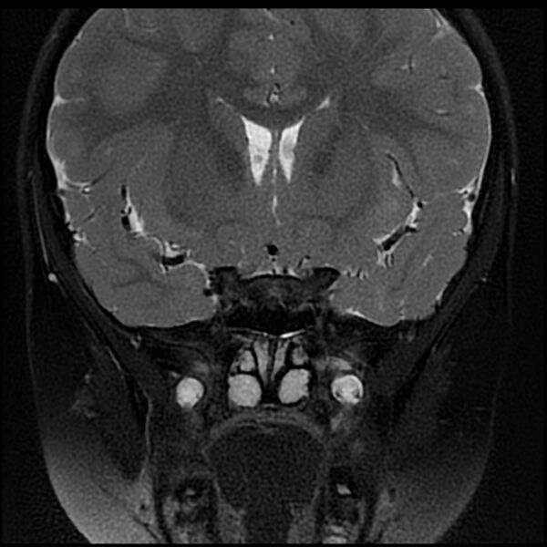 File:Adamantinomatous craniopharyngioma (Radiopaedia 77407-89529 Coronal T2 fat sat 2).jpg