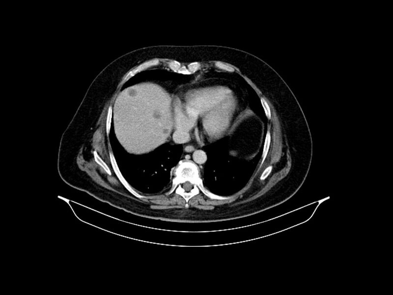 File:Adenocarcinoma of pancreas with hepatic metastasis (Radiopaedia 64332-73122 Axial C+ delayed 14).jpg