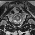 Adenoma malignum of the cervix (Radiopaedia 24460-24765 Coronal T2 18).jpg