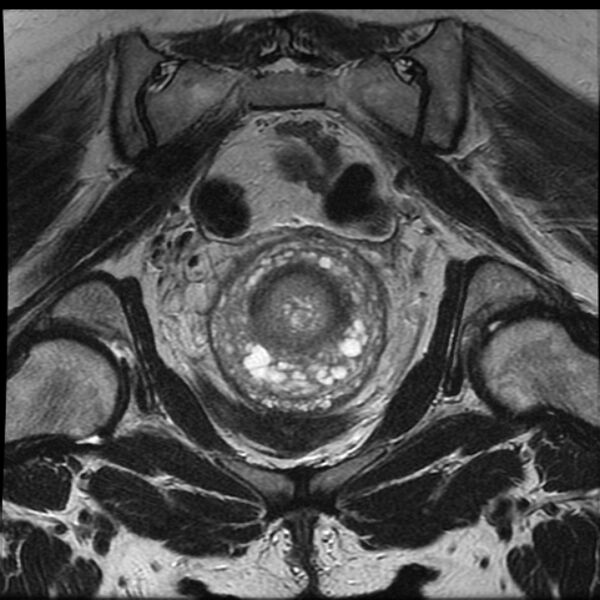 File:Adenoma malignum of the cervix (Radiopaedia 24460-24765 Coronal T2 18).jpg