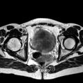 Adenomyoma of the uterus (huge) (Radiopaedia 9870-10438 Axial T2 12).jpg