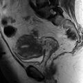 Adenomyosis of the uterus (Radiopaedia 9869-10437 Sagittal T2 3).jpg