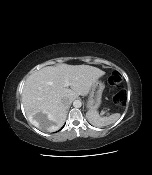 File:Adrenal cortical carcinoma with IVC invasion and thrombosis (Radiopaedia 34307-35597 Axial C+ portal venous phase 17).jpg