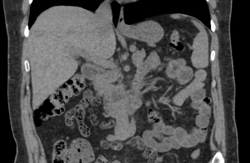 Adrenal myelolipoma (Radiopaedia 65240-74253 Coronal non-contrast 6).jpg