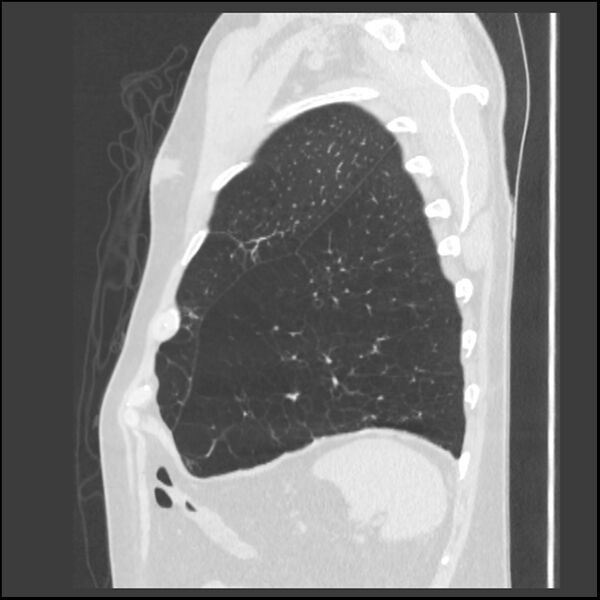File:Alpha-1-antitrypsin deficiency (Radiopaedia 40993-43722 Sagittal lung window 43).jpg