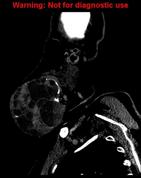 File:Ameloblastoma (Radiopaedia 33126-34164 F 13).jpg