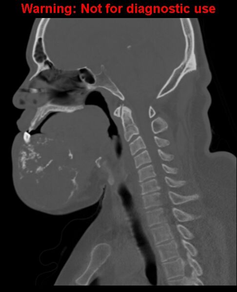 File:Ameloblastoma (Radiopaedia 33126-34164 Sagittal bone window 40).jpg
