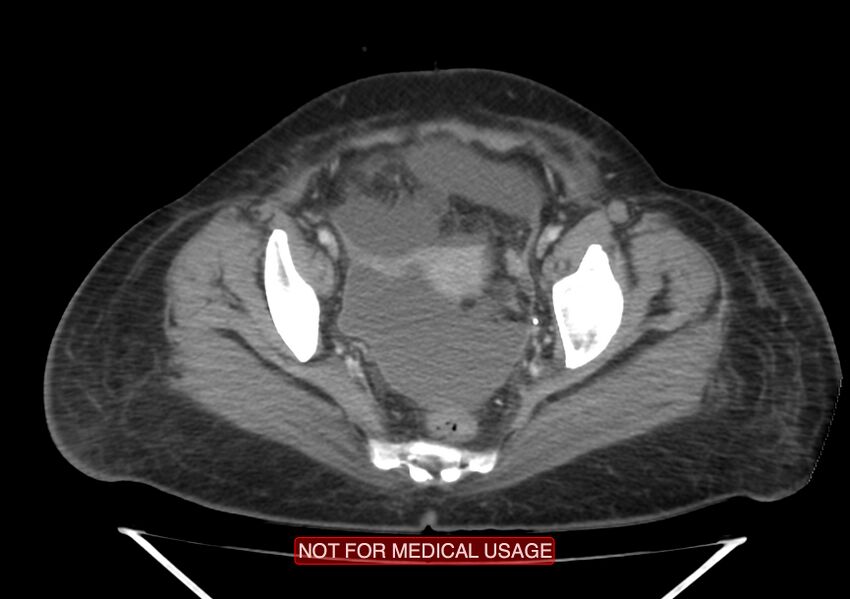 Amoebic enterocolitis with liver abscess (Radiopaedia 35100-36609 A 72).jpg