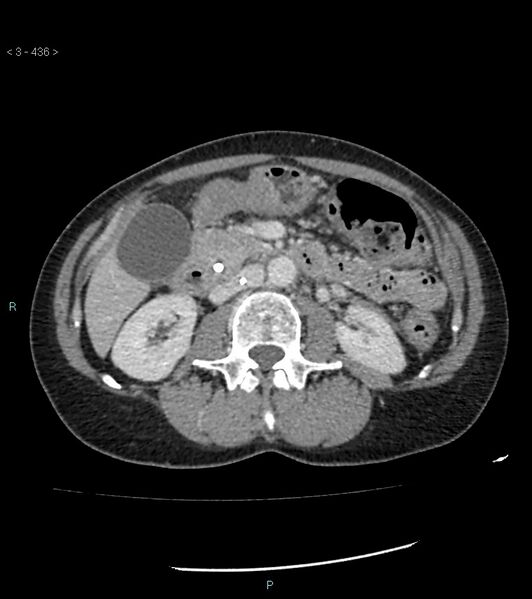 File:Ampulla of Vater metastasis (Radiopaedia 27820-28069 A 74).jpg