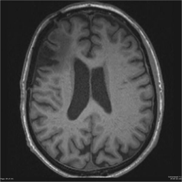 File:Anaplastic meningioma with recurrence (Radiopaedia 34452-35788 Axial T1 87).jpg