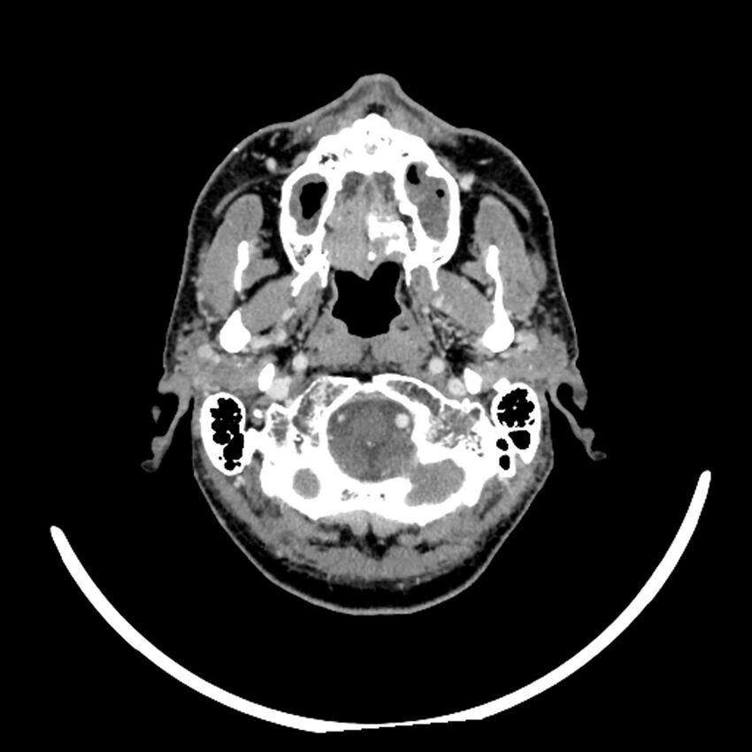 Anaplastic thyroid carcinoma (Radiopaedia 79087-92034 B 109).jpg