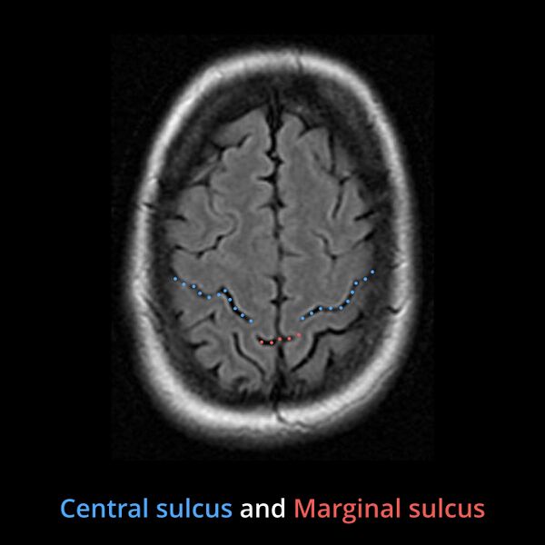 File:Anatomy- sulci of the brain (Radiopaedia 33834-34995 B 2).jpg