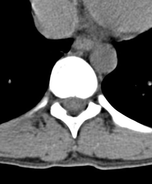File:Aneurysmal bone cyst T11 (Radiopaedia 29294-29721 Axial non-contrast 27).jpg