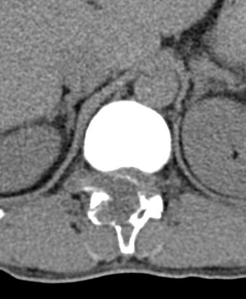 File:Aneurysmal bone cyst T11 (Radiopaedia 29294-29721 Axial non-contrast 47).jpg