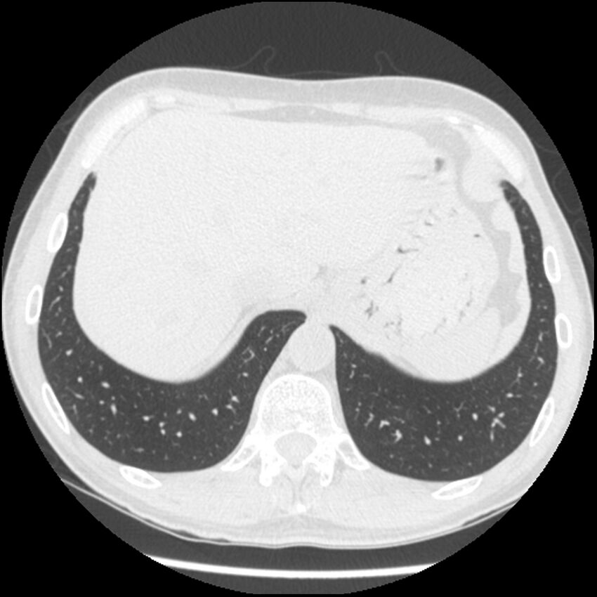 Angioinvasive aspergillosis (Radiopaedia 43957-47466 Axial lung window 60).jpg