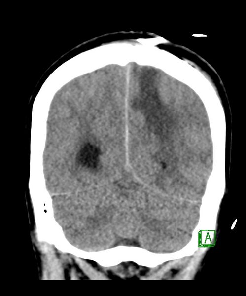 File:Angiomatous meningioma (Radiopaedia 79459-92578 Coronal non-contrast 29).jpg