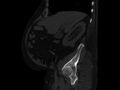 Ankylosing spondylitis (Radiopaedia 44609-48357 Sagittal bone window 27).jpg