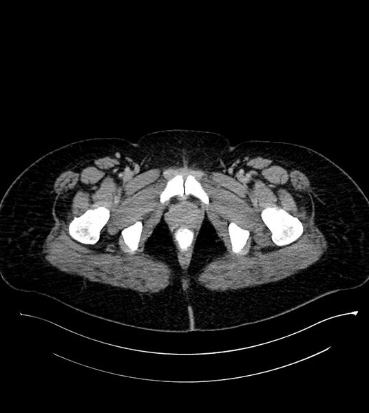 File:Anterior abdominal wall CSF pseudocyst (CSFoma) (Radiopaedia 79453-92571 A 94).jpg